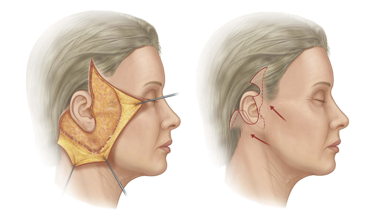 O que é lifting facial e o que ele realmente trata?